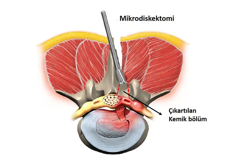 Bel fıtığı ameliyatı sırasında kullanılan modern mikrodiskektomi tekniğini gösteren, cerrahi aletlerin fıtıklaşmış diske minimal bir kesiden ulaştığı tıbbi illüstrasyon
