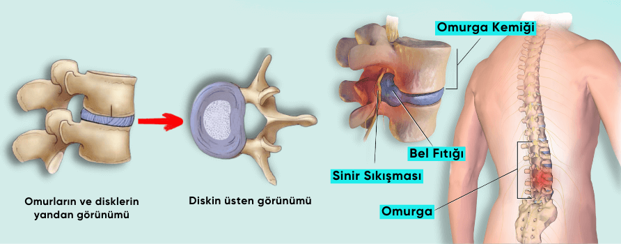 Bel fıtığı ameliyatı gerektiren, omurlar arasından taşmış ve siyatik sinirine baskı yapan fıtıklaşmış diskin anatomik gösterimi
